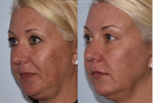 Chemical-Peels-Before-After-w.jpg