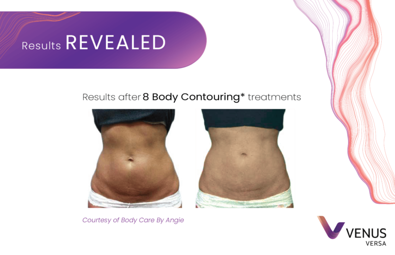 Body Contouring