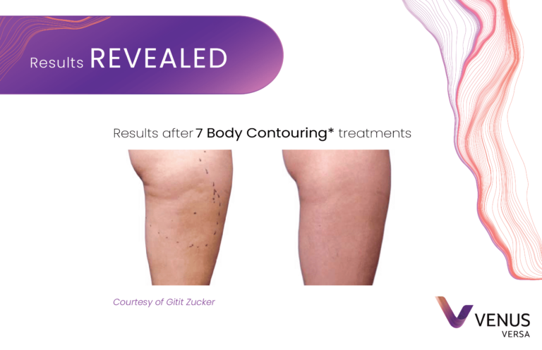 Body Contouring