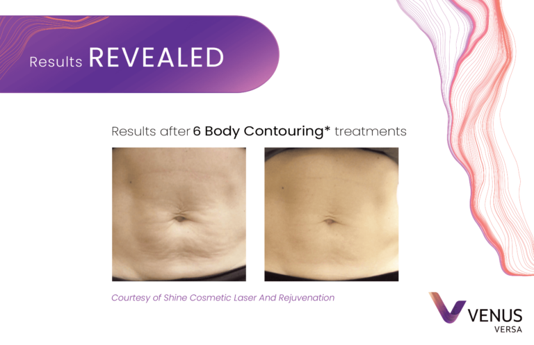 Body Contouring