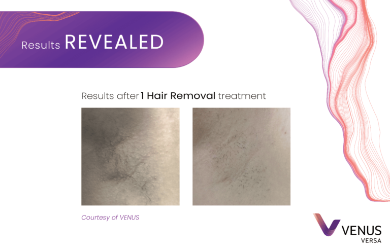 Hair Removal