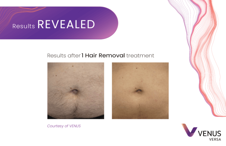 Hair Removal