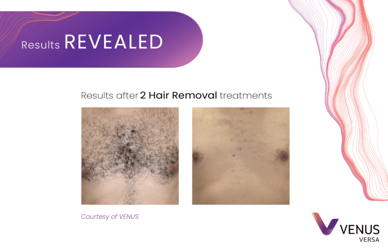 Hair Removal