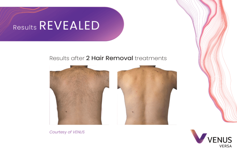 Hair Removal