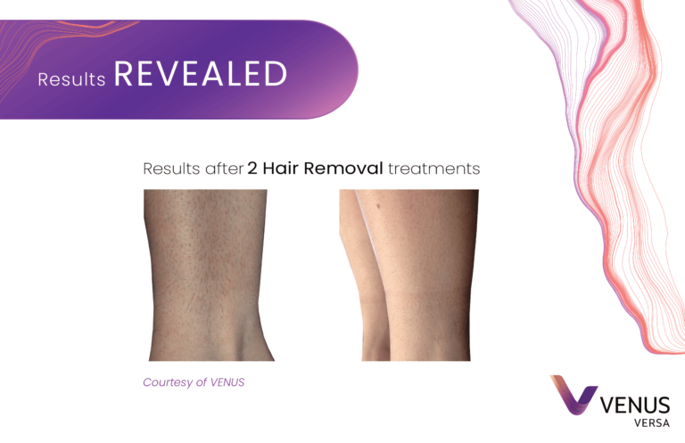 Hair Removal