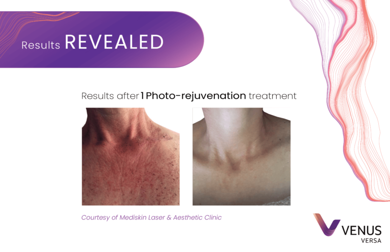 Photorejuvenation