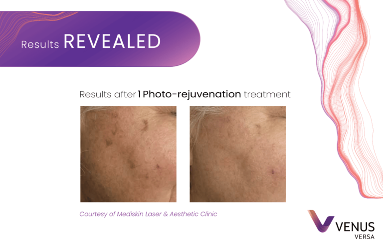 Photorejuvenation