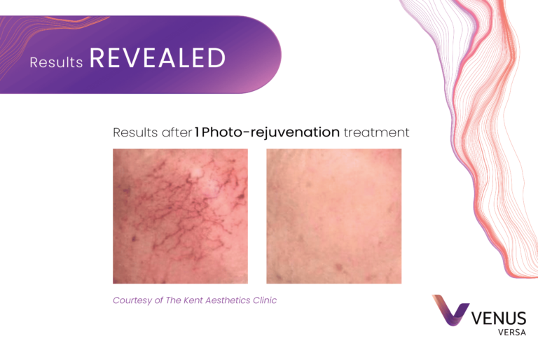 Photorejuvenation