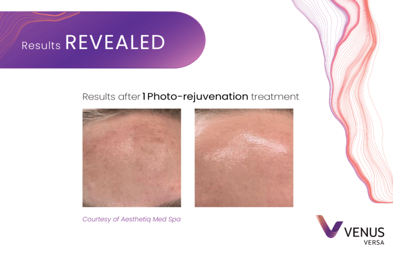 Photorejuvenation