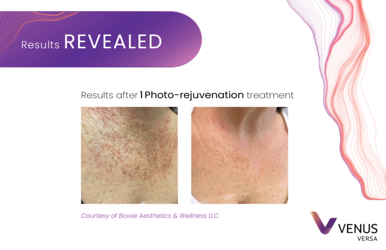 Photorejuvenation