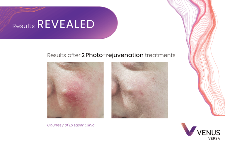 Photorejuvenation