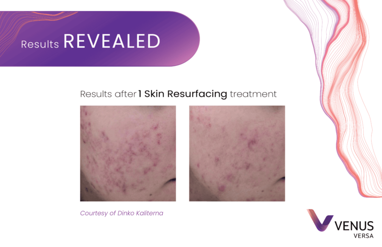 Skin Resurfacing