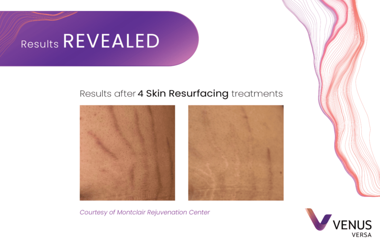 Skin Resurfacing