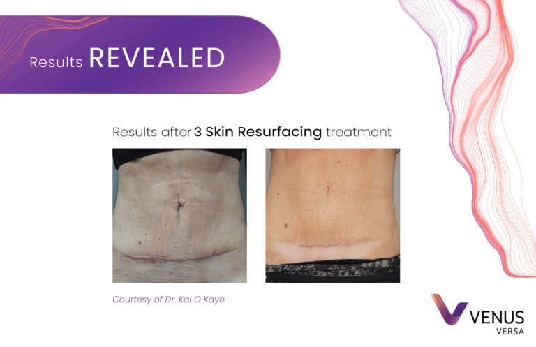 Skin Resurfacing