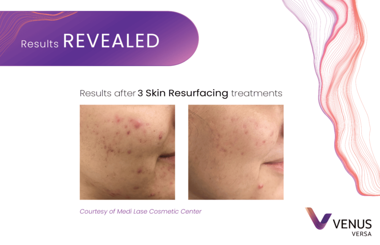 Skin Resurfacing