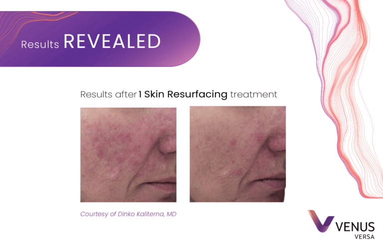 Skin Resurfacing