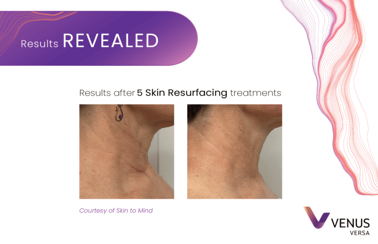 Skin Resurfacing