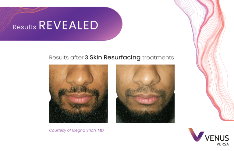 Skin Resurfacing