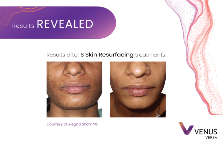 Skin Resurfacing