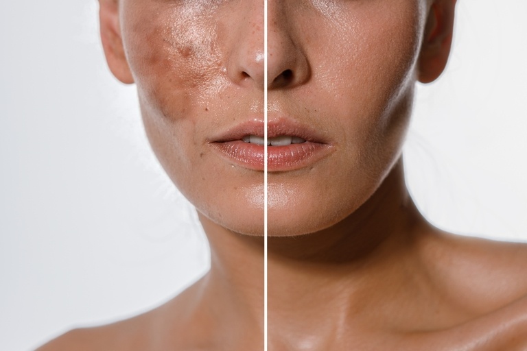 Laser hair treatment at Artistry Skin & Hormone, providing personalized care in Littleton, CO.