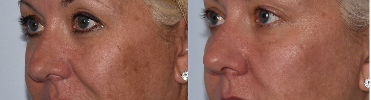 Woman's beautiful results from facials & peels treatment, chemical peel specifically, at Artistry Skin & Hormone.